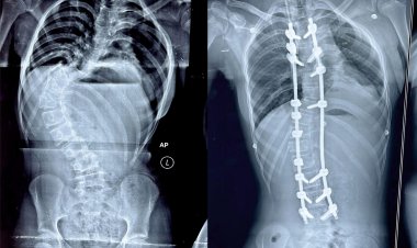 KIMS Doctors Achieve Breakthrough, Saves Young Girl’s Life with Complex Spine Surgery : Ommtv